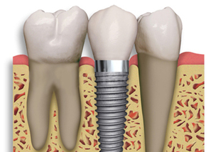 Qu’est ce qu’une dent artificielle ?