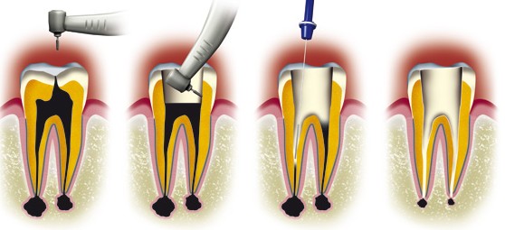 Devitaliser une dent consiste a retirer completement le nerf
