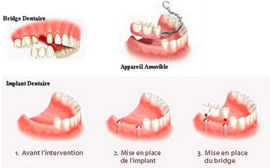 les possibilités pour remplacer une ou plusieurs dents