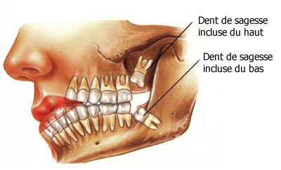 Dent de sagesse – Zeta Dental